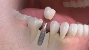 corona dentale